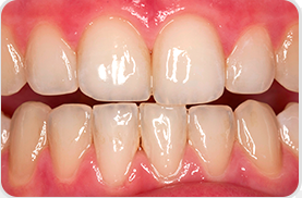 Before Whitening