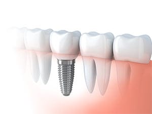 replacing missing teeth, dental implant