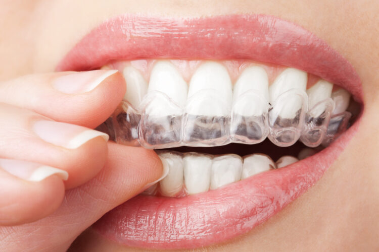 teeth straightening, clear teeth aligner trays, clear braces